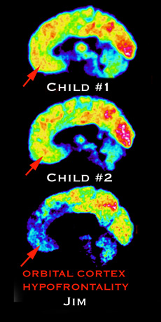 Compared to two 'healthy' brains, Jim's seems to have a gap in the centres for ethics and morality.