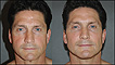 Ed Smith, before and after his cosmetic procedure