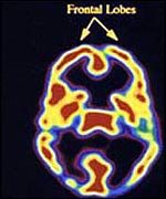 Brain imaging, BBC