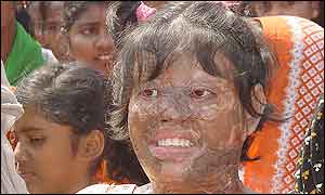 Acid attack victim