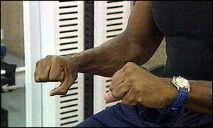 Trembling in the limbs is a symptom of Parkinson's