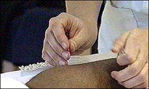Acupuncture
