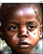 Starving boy in Malawi