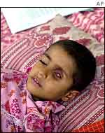 Child with eye tumour   AP