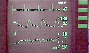 Heart failure sufferers often feel short of breath