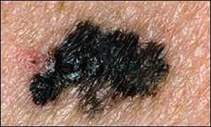 Melanoma