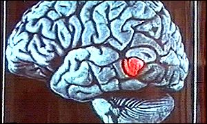 In a stroke, the blood flow to the brain is disrupted