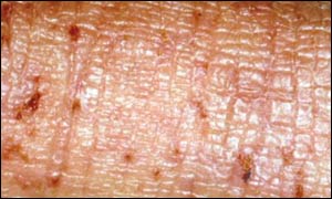 Eczema sufferer