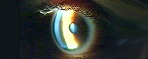 Kate's sight is gradually deteriorating