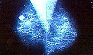 Breast cancer tumour