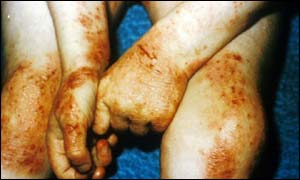 Eczema