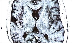 The treatment is delivered directly to the brain