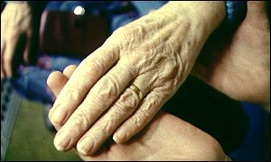 Hands affected by rheumatoid arthritis