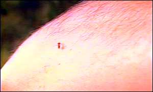 Mosquito on skin