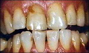 Teeth problems.