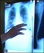 X-ray