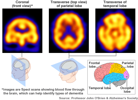 Normal brain