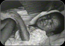 A young boy suffering from Smallpox