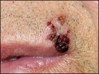 herpes