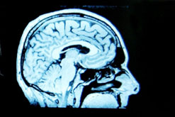 Brain scan