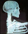 x-ray