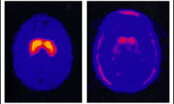 MRI scan