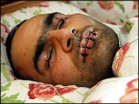 يک پناهجو که در اعتراض به اخراج از اروپا، لبهايش را دوخته بود