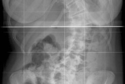 X-Ray