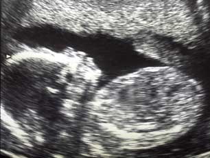 Ultrasound scan image Ultrasound scan image