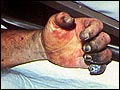 aphotograph showing the blackening of the fingers, which gives the disease its common nickname.