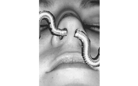 Worms
