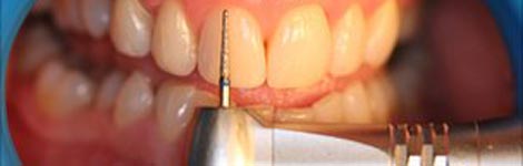 Dentist's drill