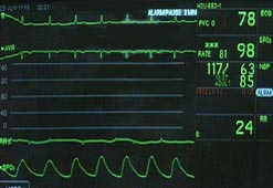 A monitor showing heartbeats