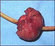 A cancerous prostate gland