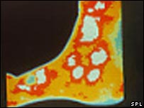 Termograma mostra feridas causadas por diabetes