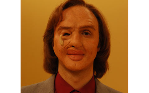 Jack After Surgery