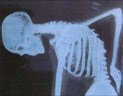 An x-ray of a skeleton with a bad back